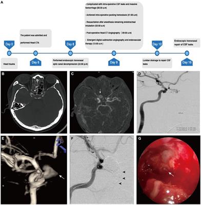 Managing intraoperative rupture of internal carotid pseudoaneurysms during endoscopic transnasal optic canal decompression: a case report